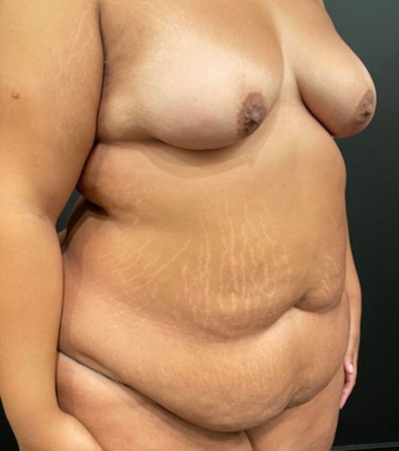 Tummy Tuck Before & After Gallery - Patient 252222 - Image 3