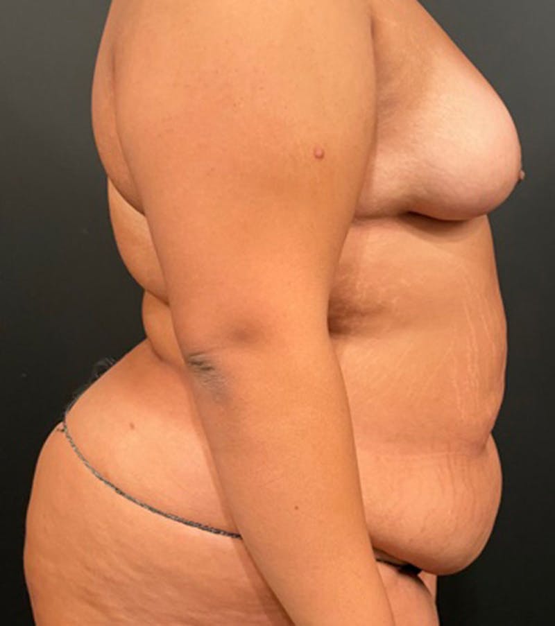 Tummy Tuck Before & After Gallery - Patient 252222 - Image 5