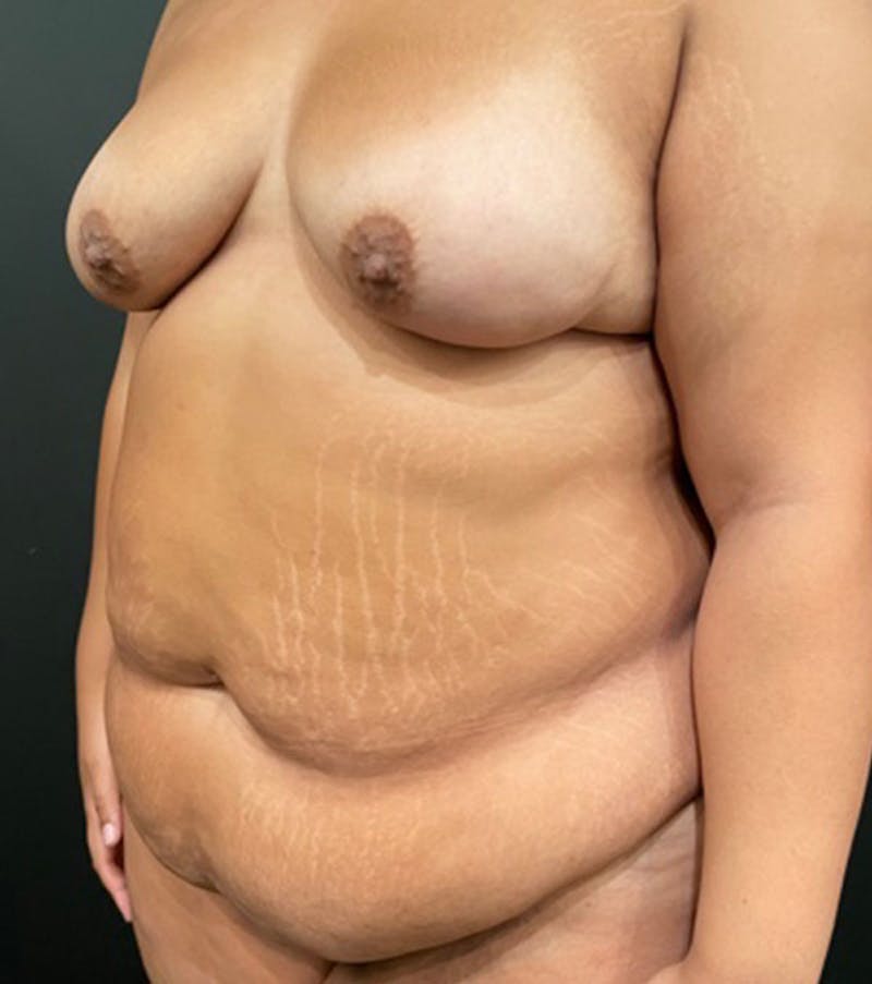 Tummy Tuck Before & After Gallery - Patient 252222 - Image 7