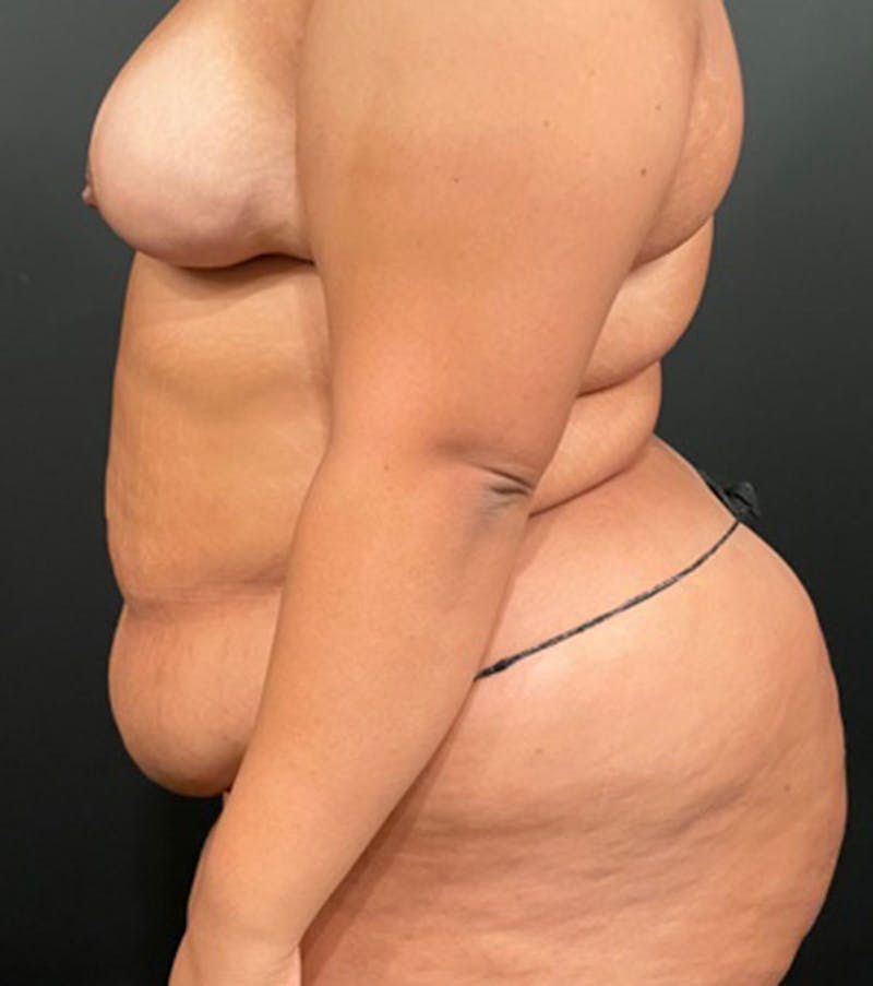 Tummy Tuck Before & After Gallery - Patient 252222 - Image 9
