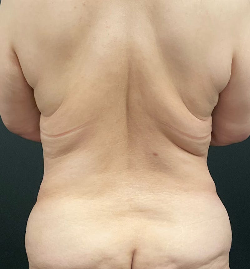 Bra Line Back Lift ™ Before & After Gallery - Patient 105987 - Image 1