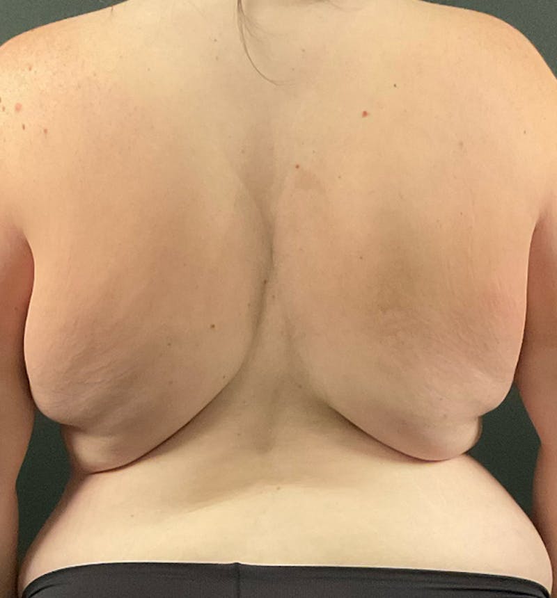 Bra Line Back Lift ™ Before & After Gallery - Patient 199557 - Image 1