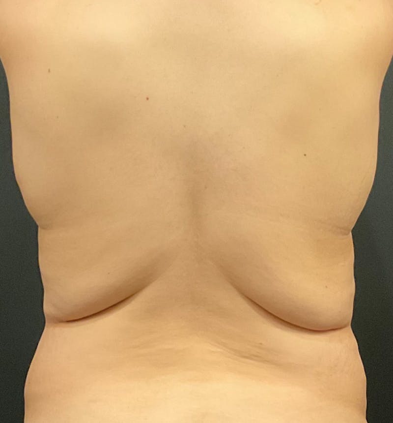 Bra Line Back Lift ™ Before & After Gallery - Patient 258959 - Image 1