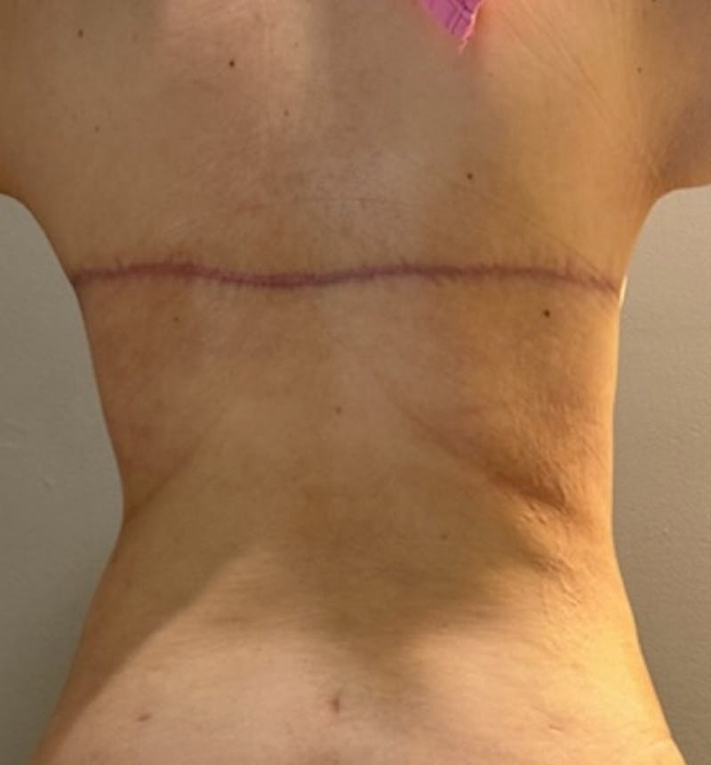 Bra Line Back Lift ™ Before & After Gallery - Patient 258959 - Image 2