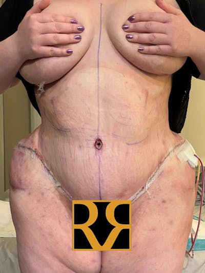 Plus Size Tummy Tuck ® Before & After Gallery - Patient 407084 - Image 2