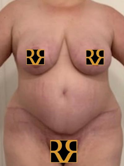 Plus Size Tummy Tuck ® Before & After Gallery - Patient 380277 - Image 2
