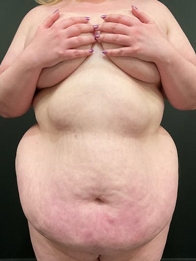 Plus Size Tummy Tuck: Week After Surgery Before & After Gallery - Patient 266099 - Image 1