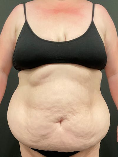 Plus Size Tummy Tuck: Day After Surgery Before & After Gallery - Patient 398726 - Image 1