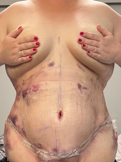 Plus Size Tummy Tuck: Day After Surgery Before & After Gallery - Patient 398726 - Image 2