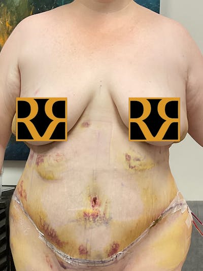 Plus Size Tummy Tuck: Week After Surgery Before & After Gallery - Patient 403961 - Image 2