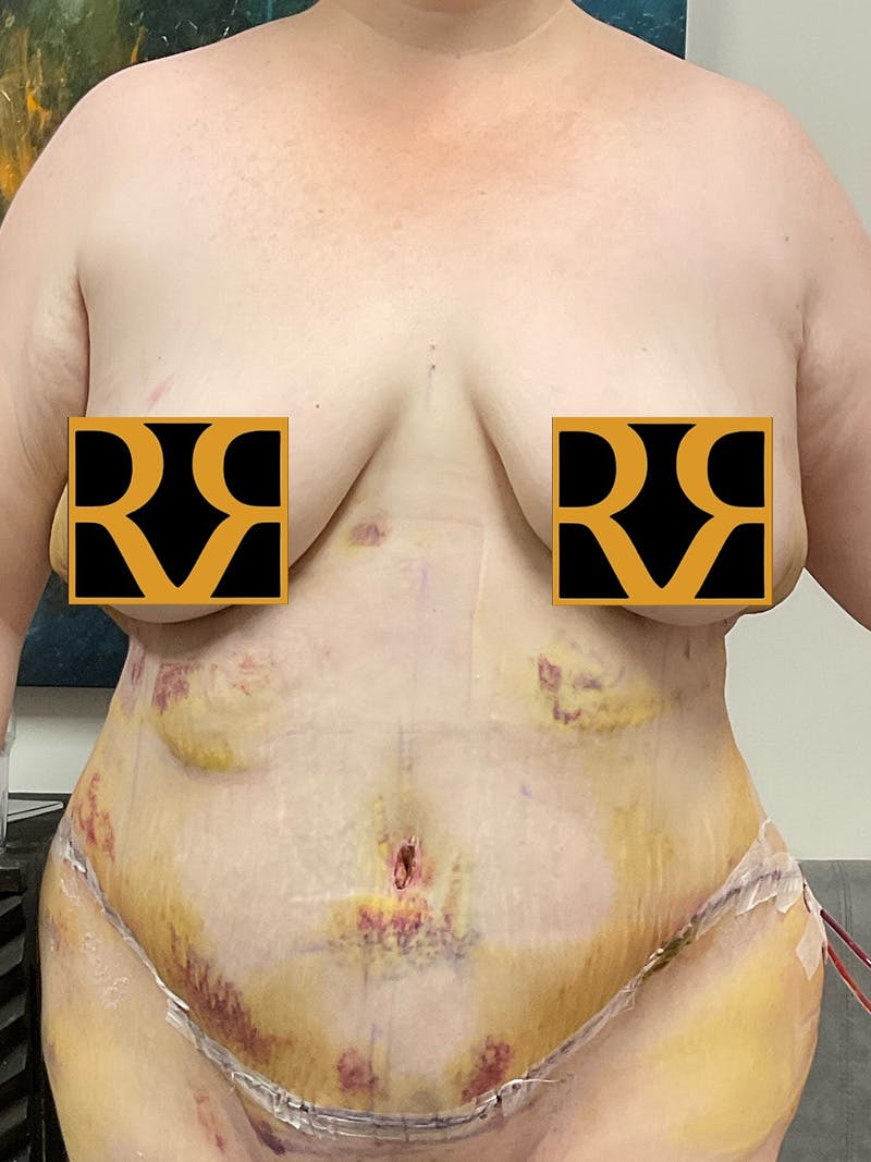 Plus Size Tummy Tuck: Week After Surgery Before & After Gallery - Patient 403961 - Image 2