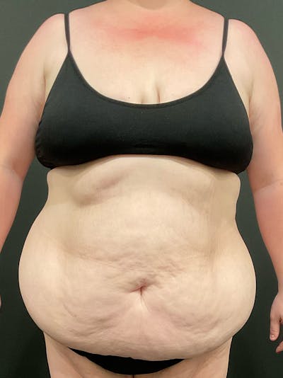 Plus Size Tummy Tuck: Week After Surgery Before & After Gallery - Patient 403961 - Image 1