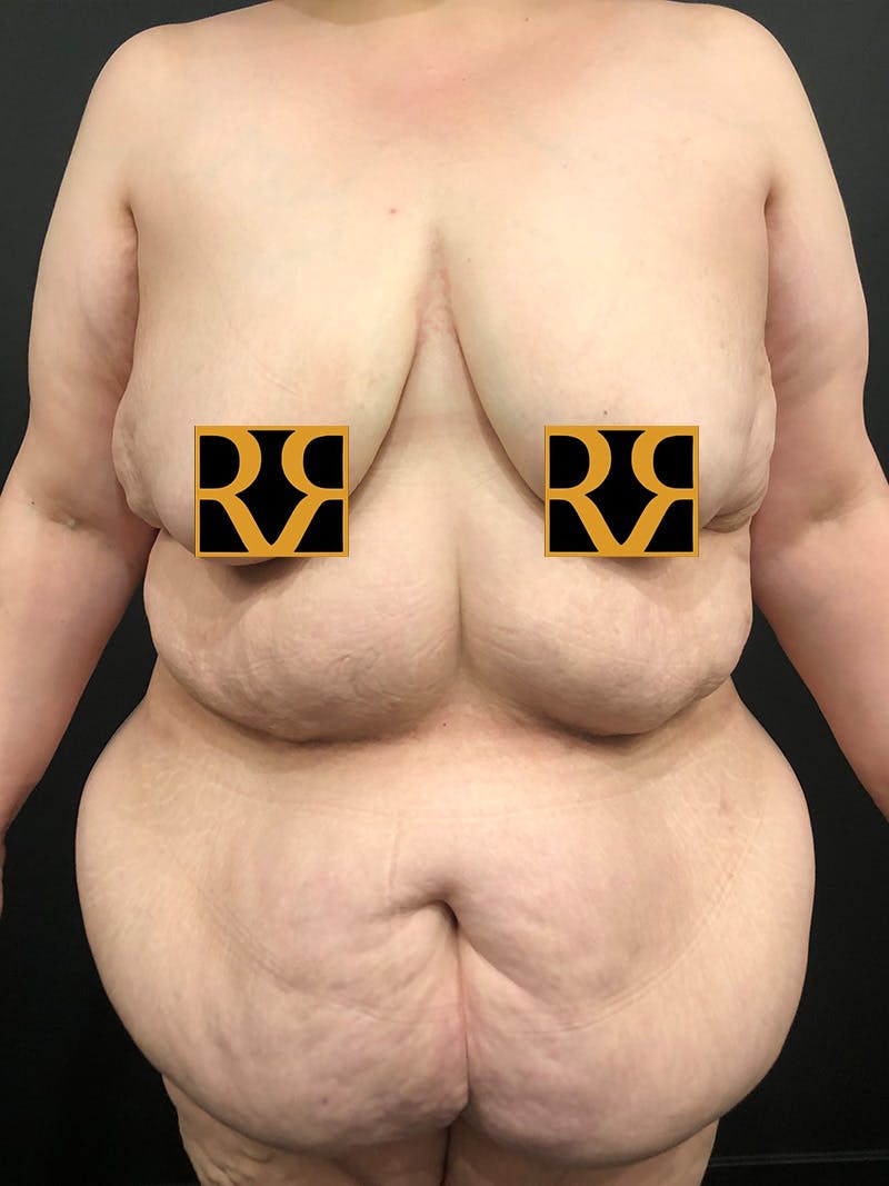 Plus Size Tummy Tuck ® Before & After Gallery - Patient 358461 - Image 1