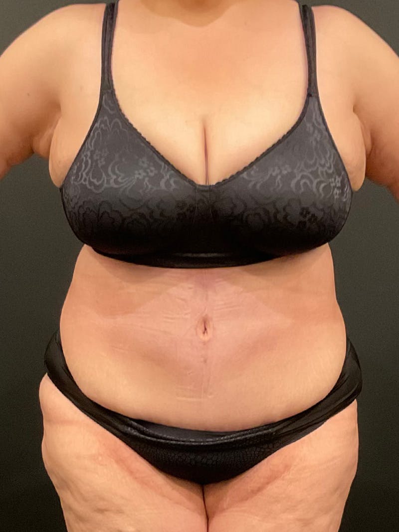 Plus Size Tummy Tuck ® Before & After Gallery - Patient 358461 - Image 2
