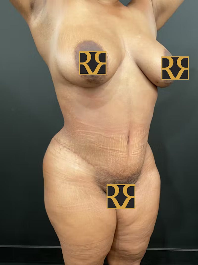 Tummy Tuck Before & After Gallery - Patient 435850 - Image 4