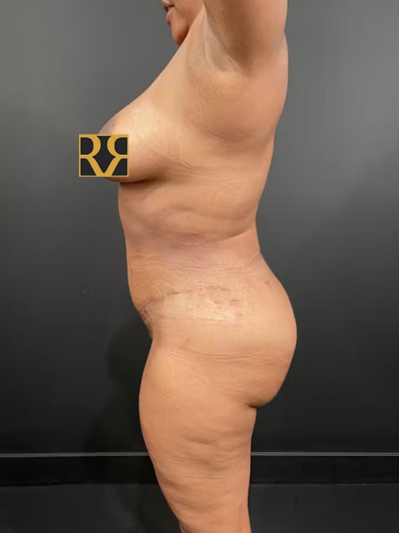 Tummy Tuck Before & After Gallery - Patient 435850 - Image 10