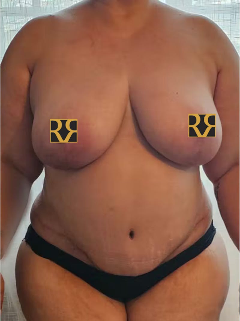 Tummy Tuck Before & After Gallery - Patient 220836 - Image 2
