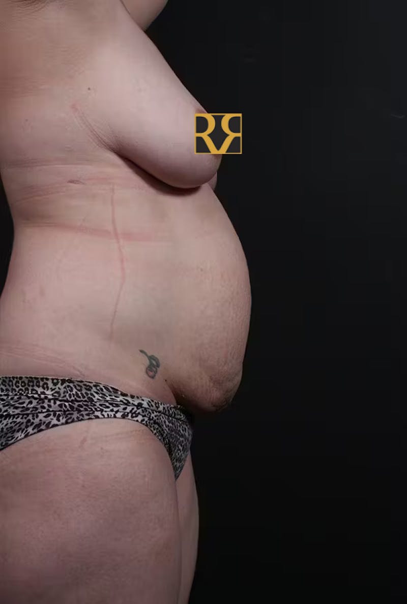Tummy Tuck Before & After Gallery - Patient 463031 - Image 5