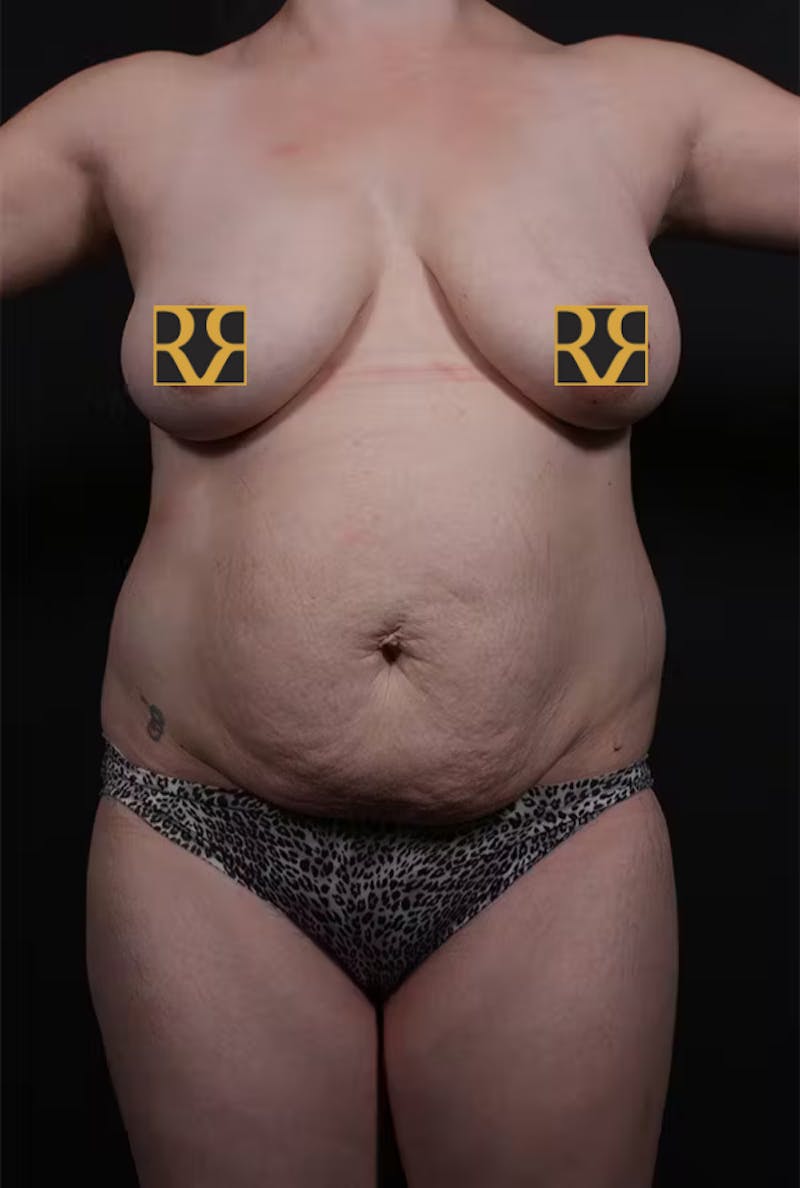 Tummy Tuck Before & After Gallery - Patient 463031 - Image 1