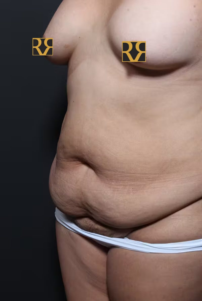 Tummy Tuck Before & After Gallery - Patient 169905 - Image 3