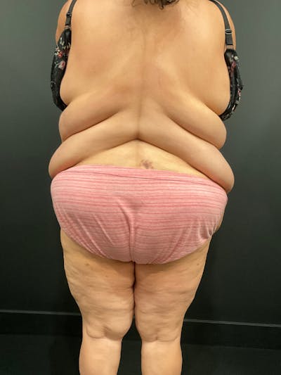 Bra Line Back Lift ™ Before & After Gallery - Patient 994583 - Image 1