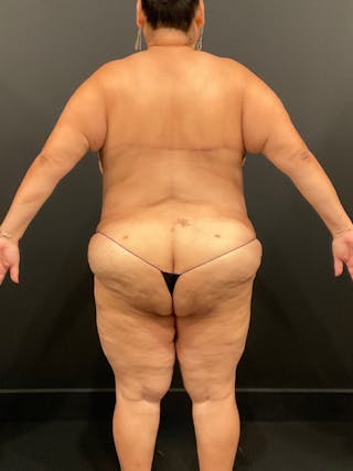 Plus Size Tummy Tuck ® Before & After Gallery - Patient 397307 - Image 12