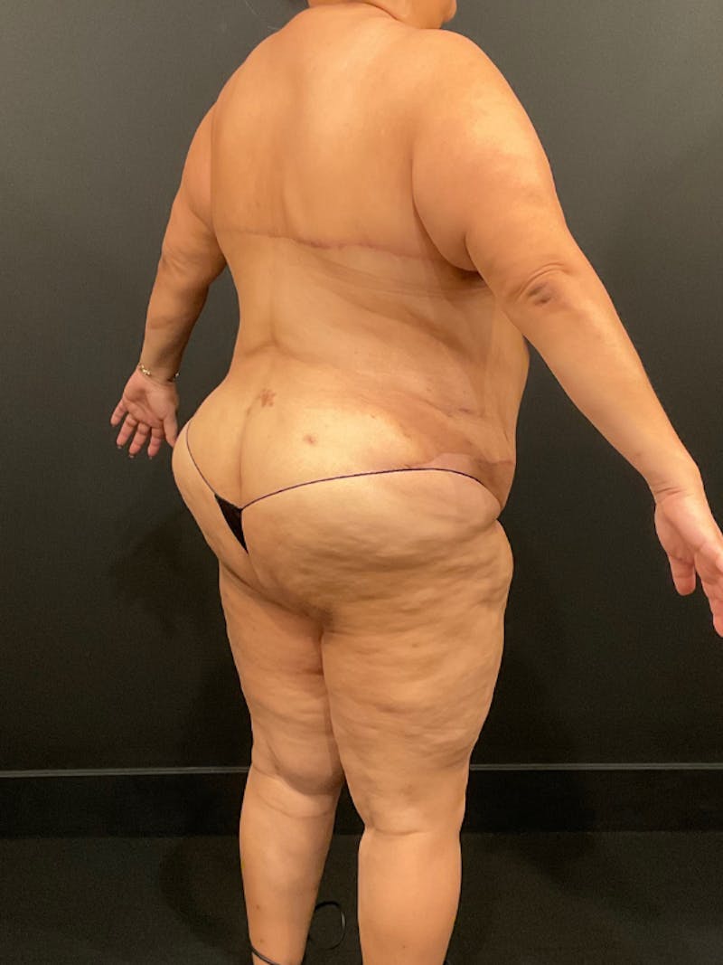 Bra Line Back Lift ™ Before & After Gallery - Patient 994583 - Image 4