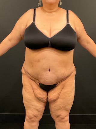 Plus Size Tummy Tuck ® Before & After Gallery - Patient 397307 - Image 2