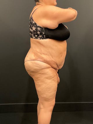 Plus Size Tummy Tuck ® Before & After Gallery - Patient 397307 - Image 6