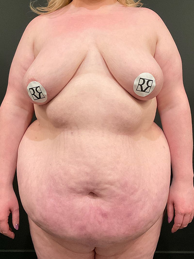 Plus Size Tummy Tuck ® Before & After Gallery - Patient 407084 - Image 1