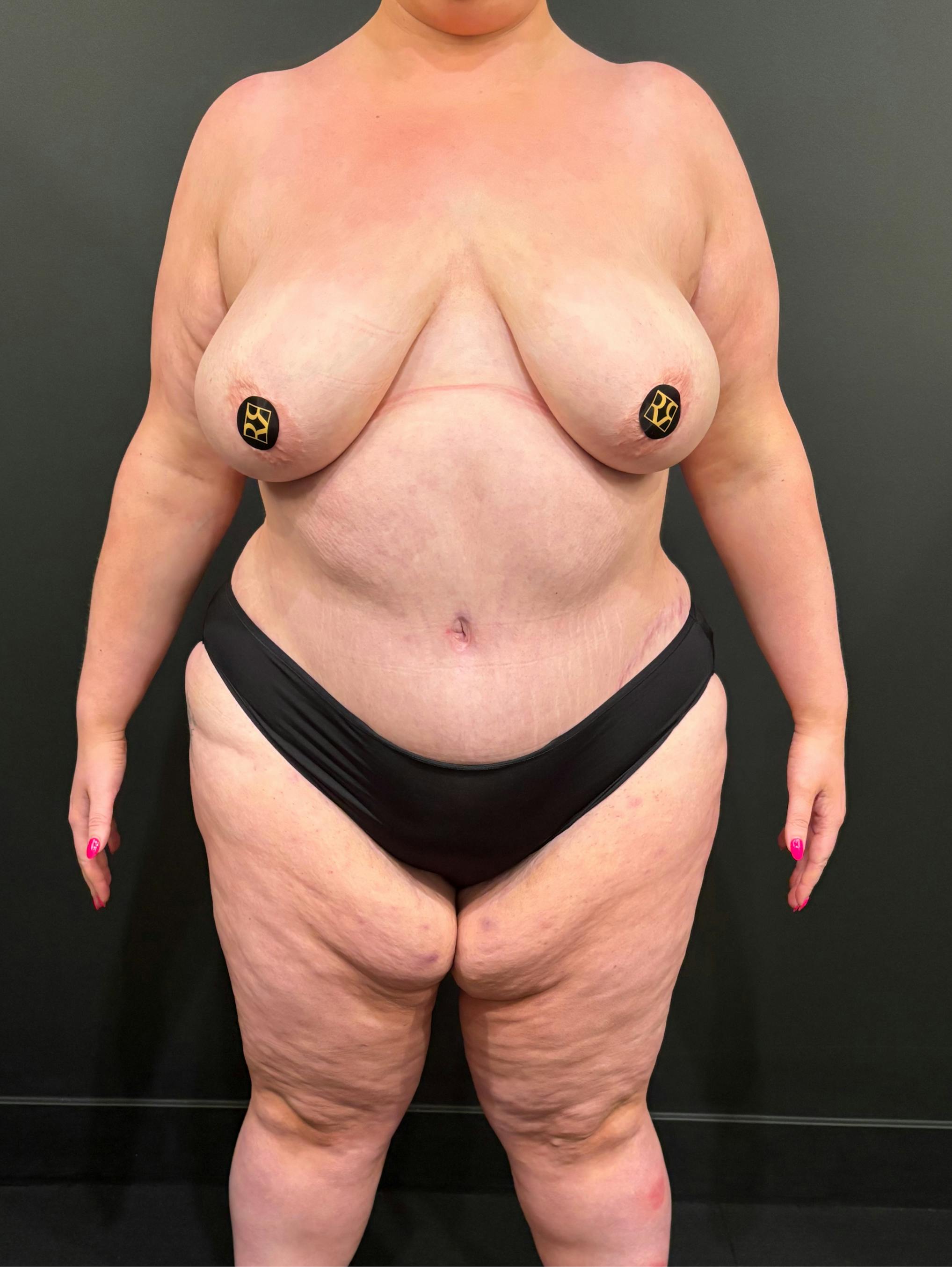 Patient D After Photo