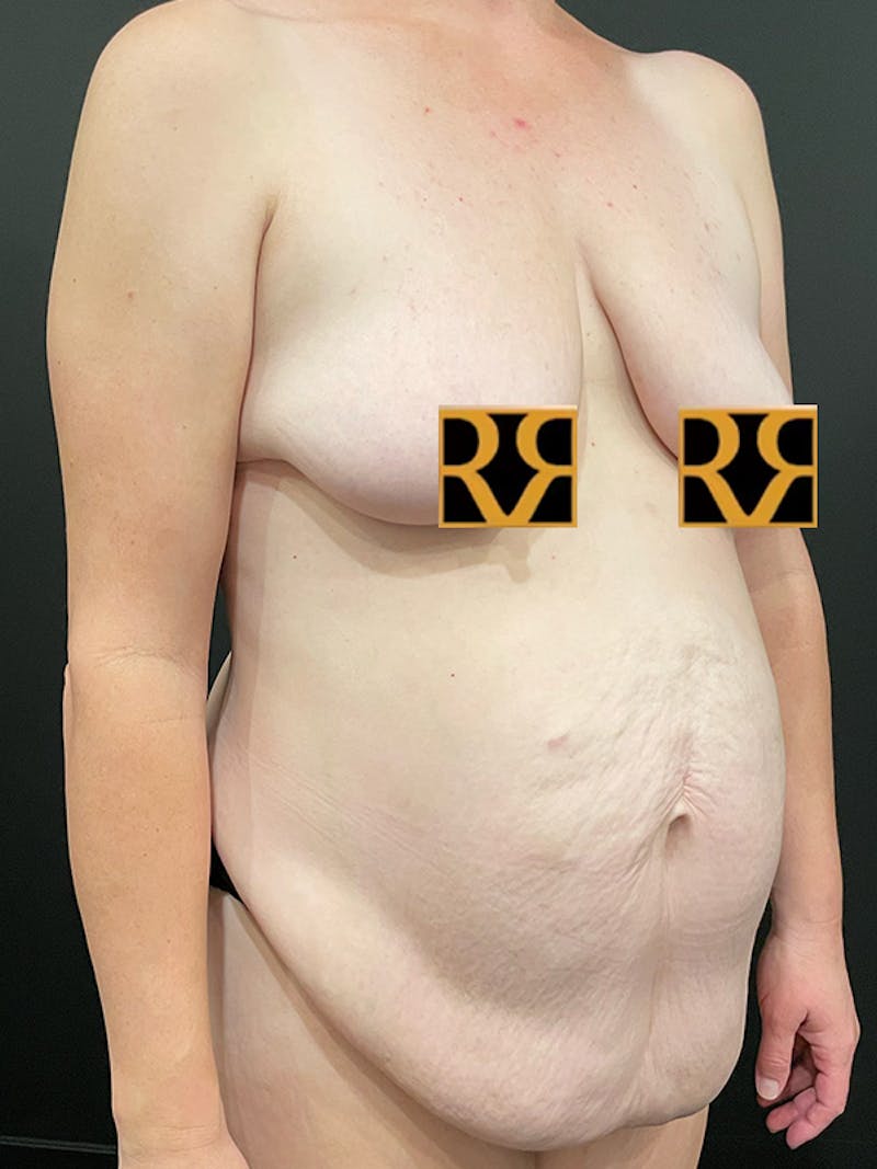 Tummy Tuck Before & After Gallery - Patient 105266 - Image 3