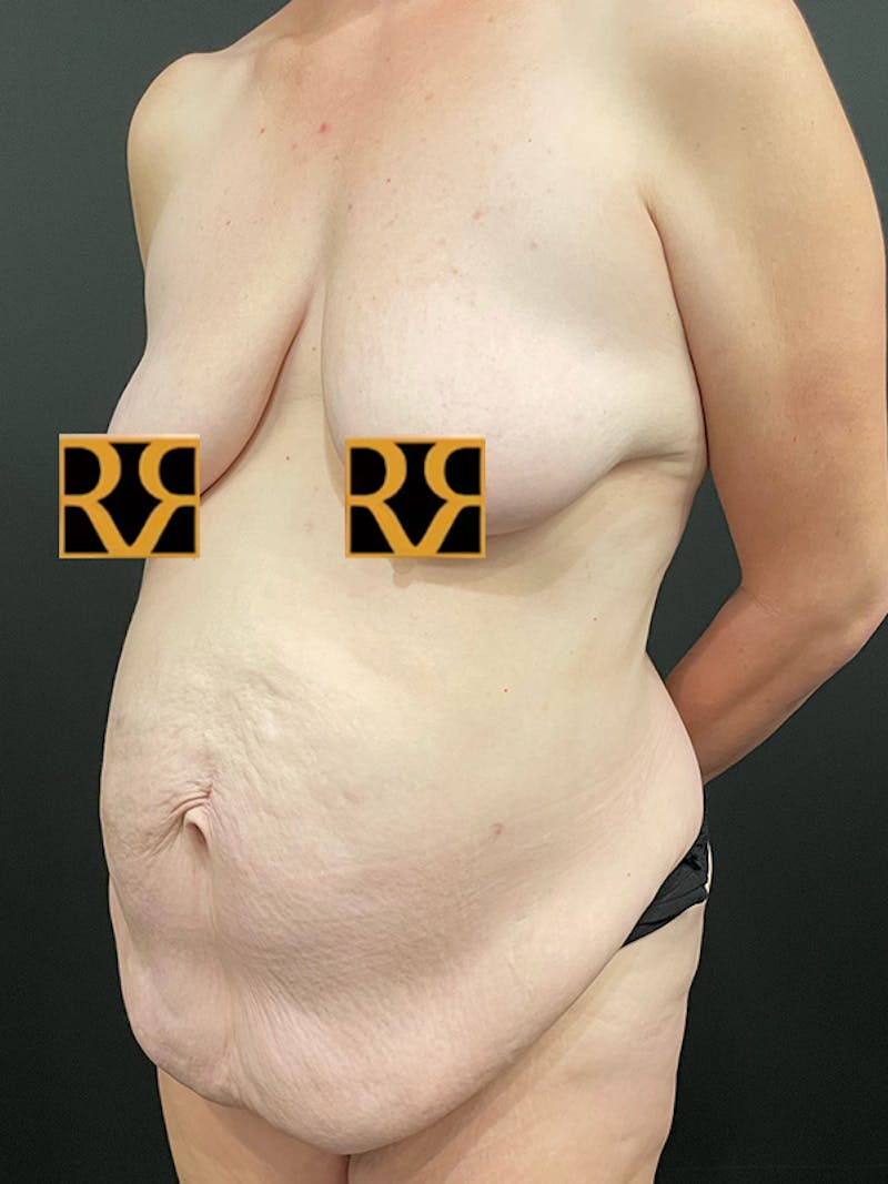 Tummy Tuck Before & After Gallery - Patient 105266 - Image 9