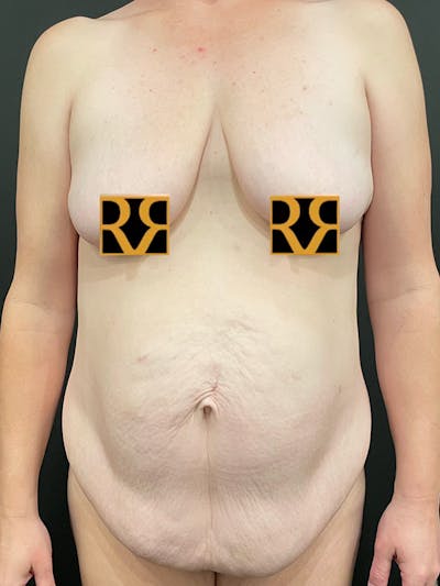 Tummy Tuck Before & After Gallery - Patient 105266 - Image 1