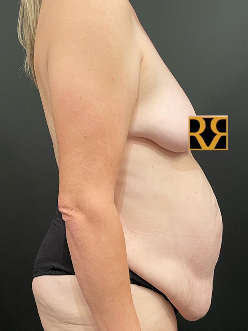 Tummy Tuck Before & After Gallery - Patient 105266 - Image 5