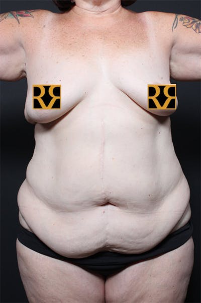 Tummy Tuck Before & After Gallery - Patient 123640 - Image 1