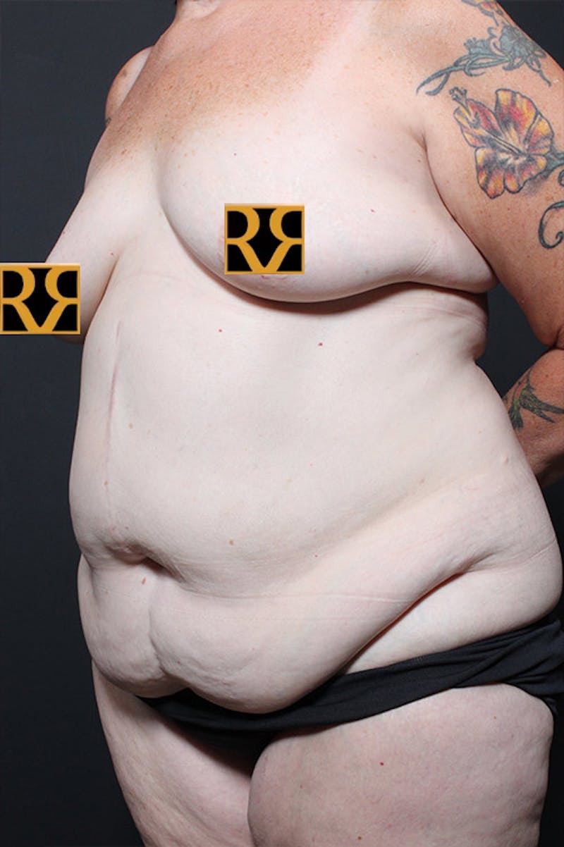 Tummy Tuck Before & After Gallery - Patient 123640 - Image 3