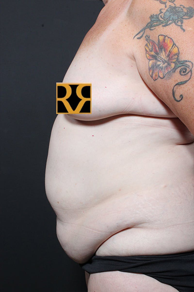 Tummy Tuck Before & After Gallery - Patient 123640 - Image 5