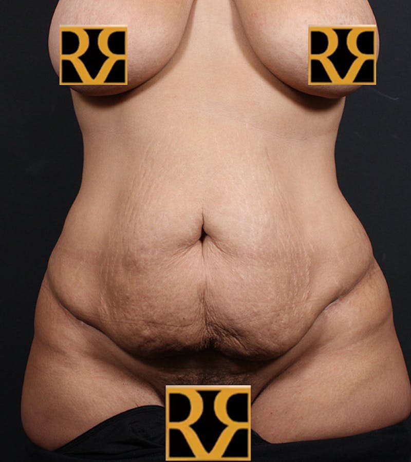 Tummy Tuck Before & After Gallery - Patient 406476 - Image 1