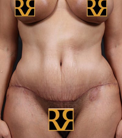 Tummy Tuck Before & After Gallery - Patient 406476 - Image 2