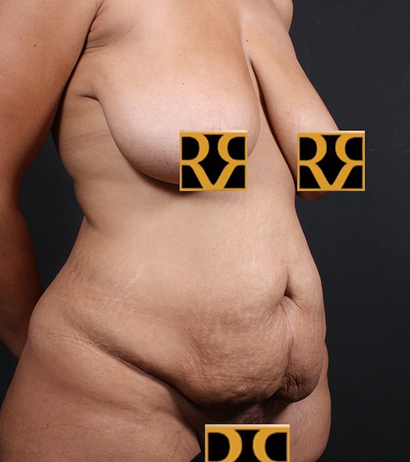 Tummy Tuck Before & After Gallery - Patient 406476 - Image 3