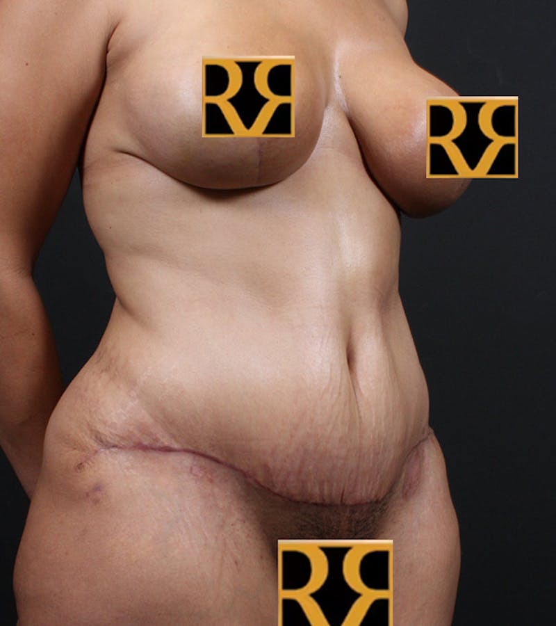 Tummy Tuck Before & After Gallery - Patient 406476 - Image 4