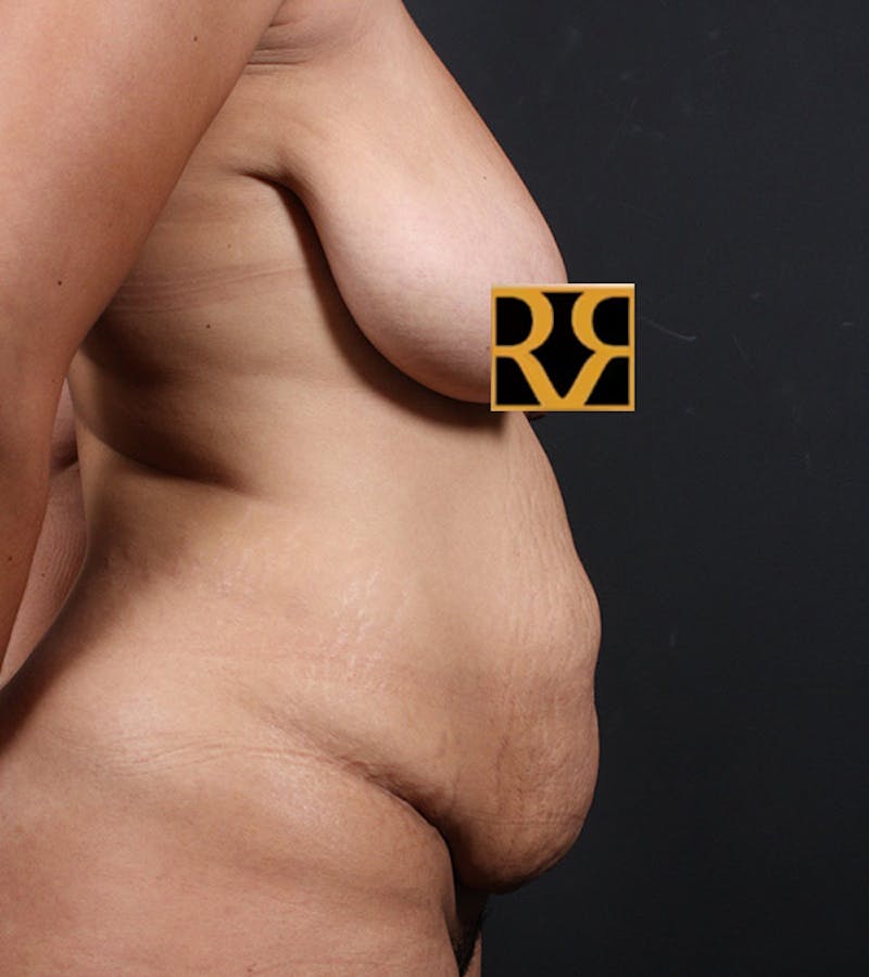 Tummy Tuck Before & After Gallery - Patient 406476 - Image 5