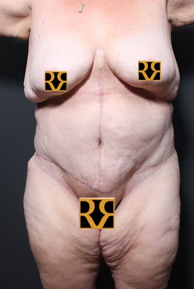 Tummy Tuck Before & After Gallery - Patient 139360 - Image 2