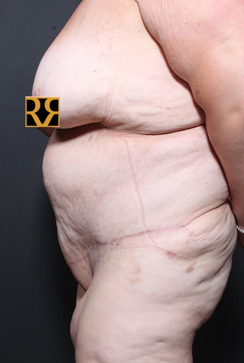 Tummy Tuck Before & After Gallery - Patient 139360 - Image 6