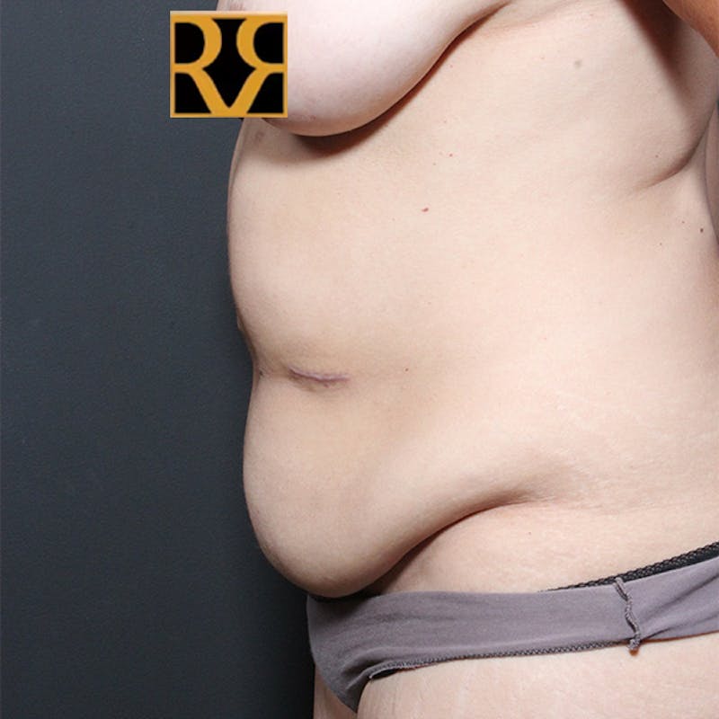 Tummy Tuck Before & After Gallery - Patient 182285 - Image 5