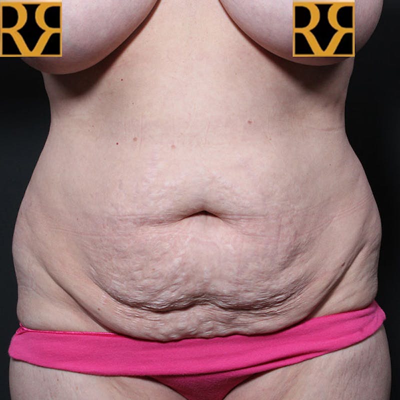 Tummy Tuck Before & After Gallery - Patient 425619 - Image 1