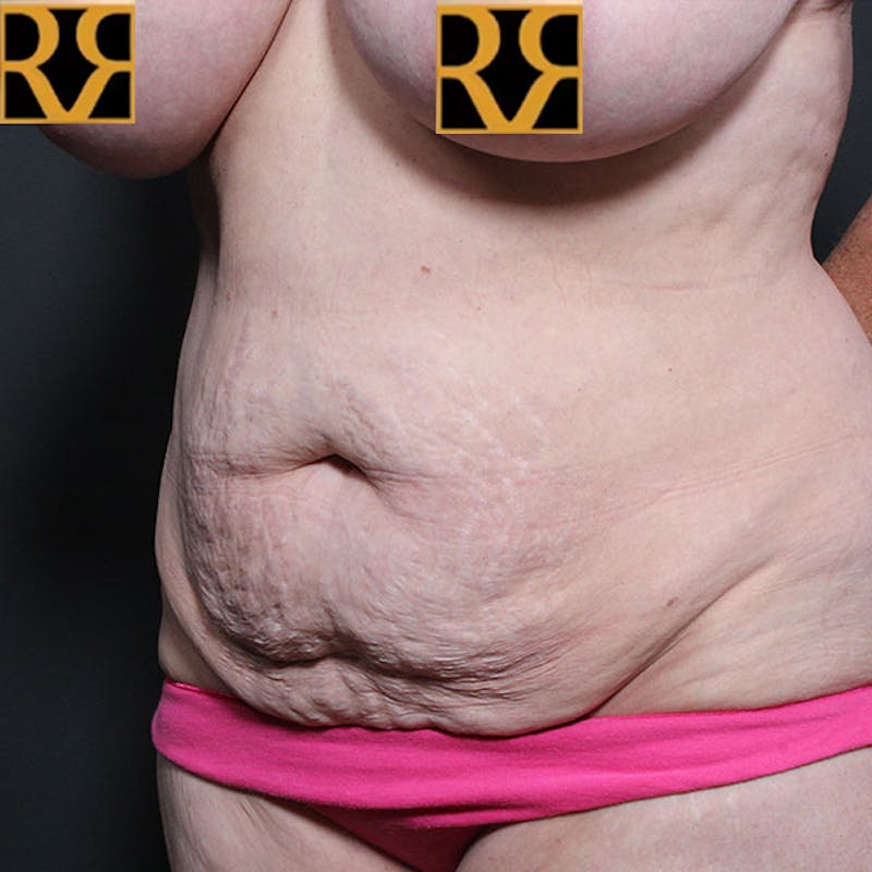 Tummy Tuck Before & After Gallery - Patient 425619 - Image 3