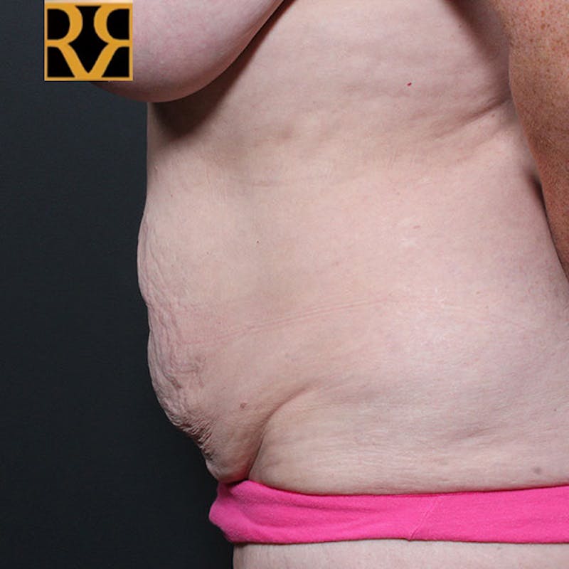 Tummy Tuck Before & After Gallery - Patient 425619 - Image 5