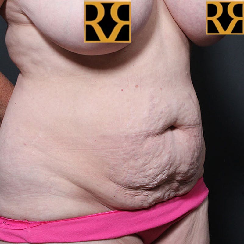 Tummy Tuck Before & After Gallery - Patient 425619 - Image 7